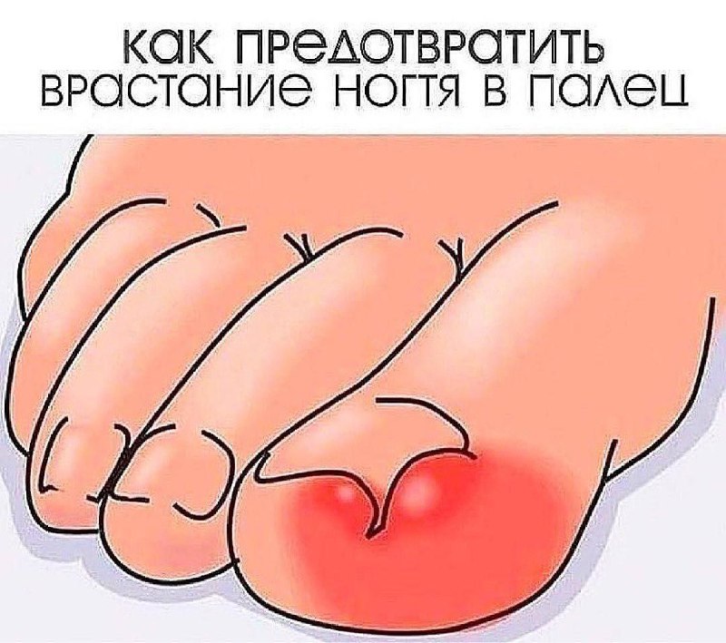 Как избежать врастания ногтя в палец: советы и рекомендации