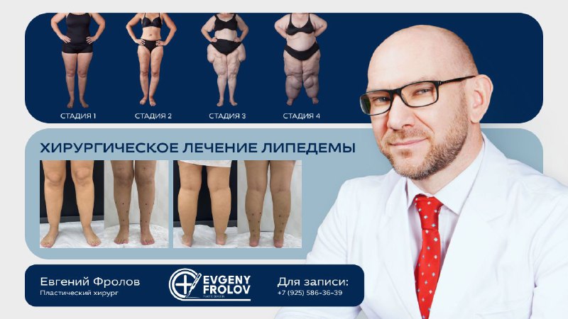 Редкая возможность получения помощи при липедеме в России