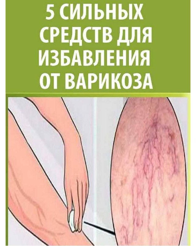 Пять эффективных народных средств при варикозе Пять эффективных народных средств при варикозе