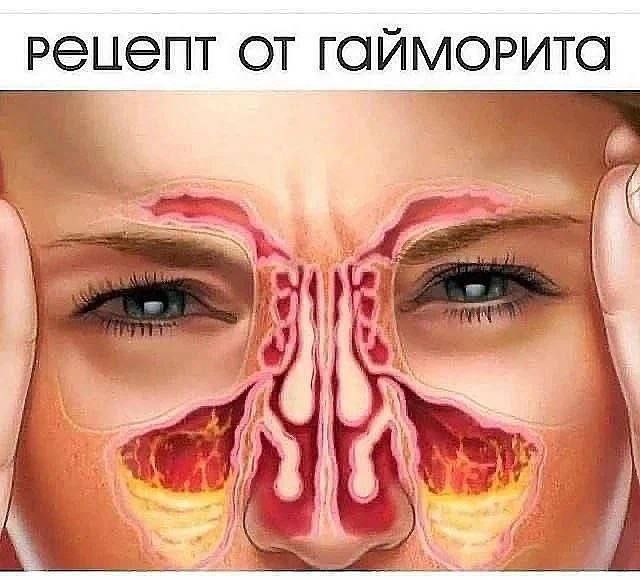 Рецепт для лечения гайморита с березовыми почками и водкой