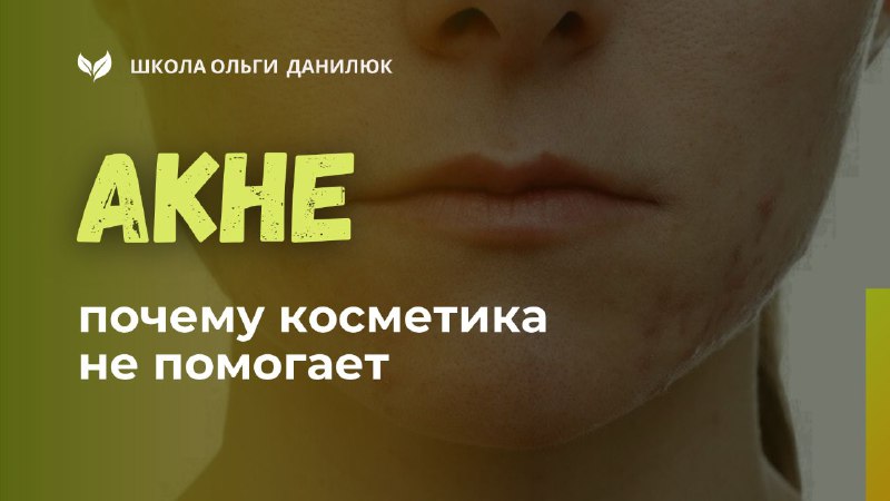 Почему косметика не помогает при подростковом акне и что действительно важно знать