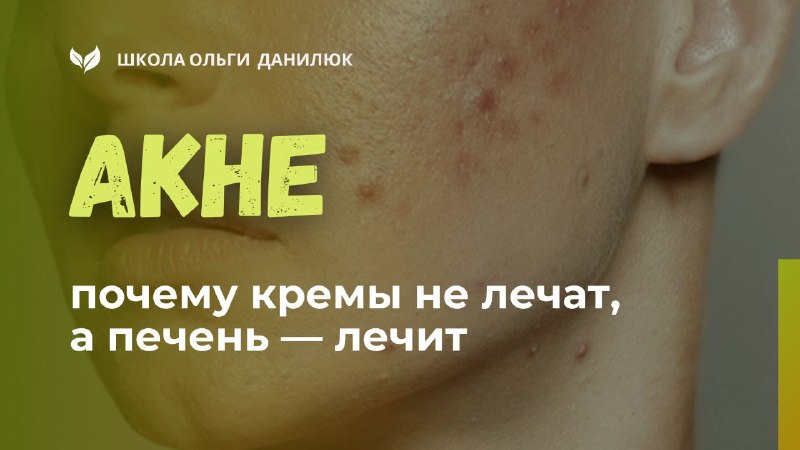 Почему кремы не избавляют от акне, а очищение печени — помогает