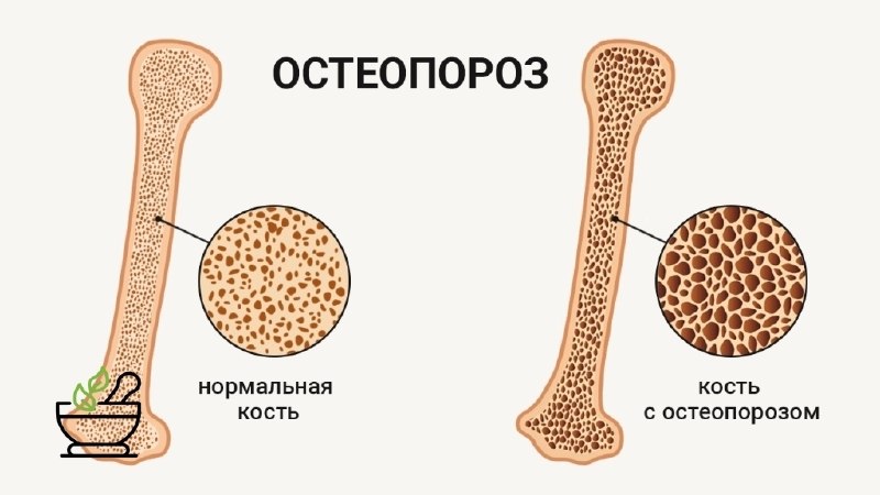 Остеопороз: рекомендации фитотерапевта по питанию и образу жизни